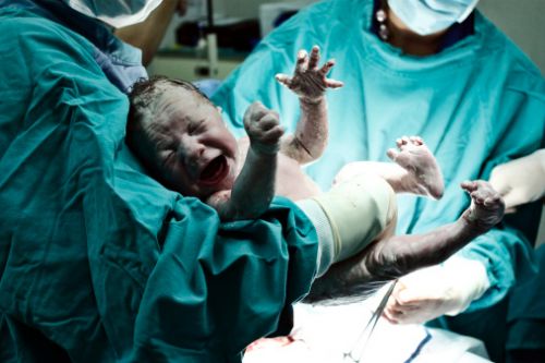 Baby After C-Section Birth