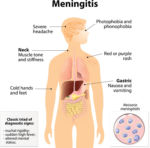 Diagram of Meningitis Symptoms